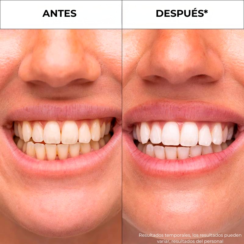 Merraci™ V34 Bandas Blanqueadoras – Blanqueamiento de Color Dental