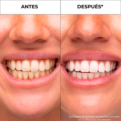 Merraci™ V34 Bandas Blanqueadoras – Blanqueamiento de Color Dental